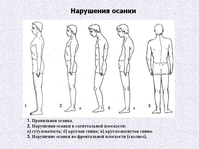 FOTO: ds02.infourok.ru La majoria de les vegades, la curvatura s’expressa en la curvatura de la columna vertebral